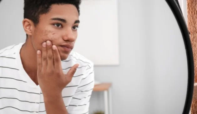 Teenage acne myths, busted