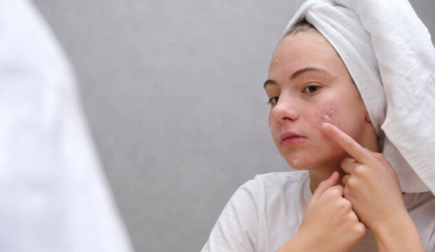 Treating teenage acne with Acnecide + Purifide
