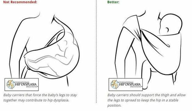 Hip dysplasia guidance on baby carriers
