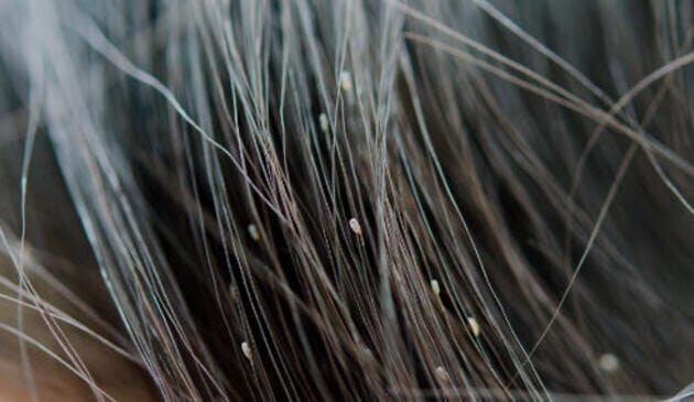 Nits in hair